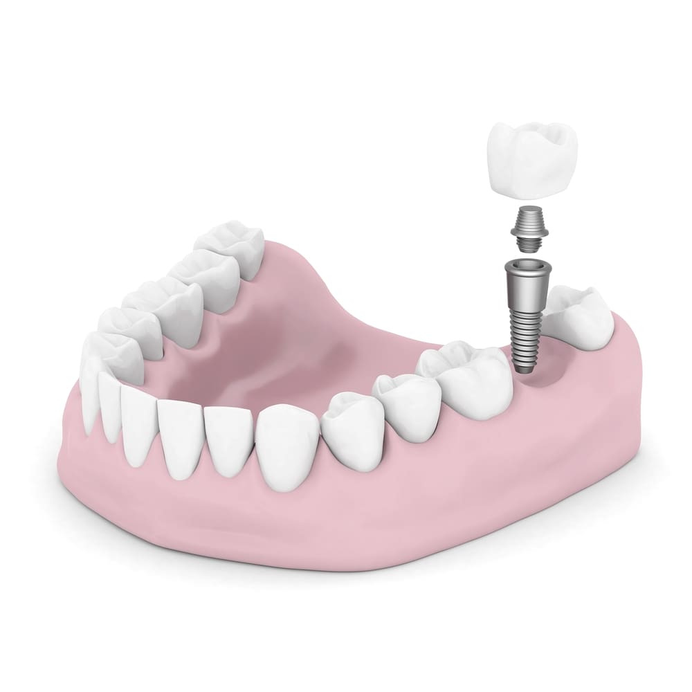 Aurora Dental Implants near me