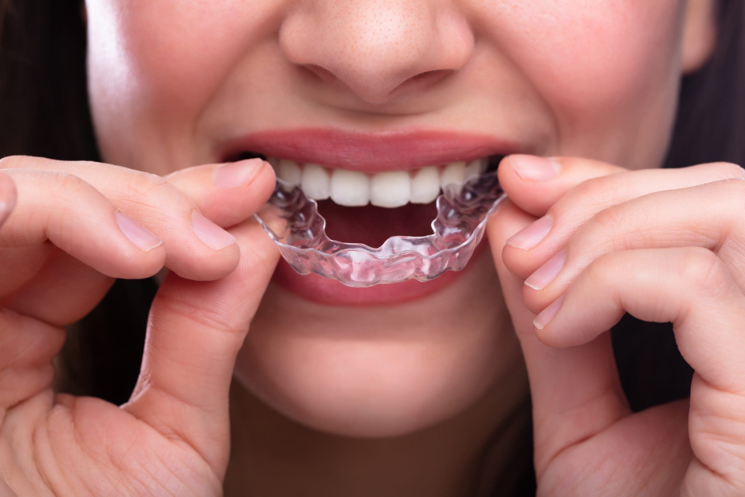 Invisalign